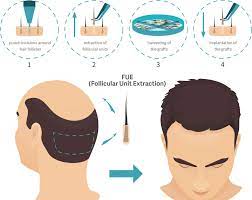 +1000€ · autotrapianto capelli + sopracciglia: Ho Fatto Il Trapianto Di Capelli In Turchia La Mia Esperienza Il Redpillatore