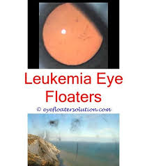 Pin On Eye Floaters Causes