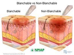 Blanchable vs Non-Blanchable - National Pressure Injury Advisory Panel