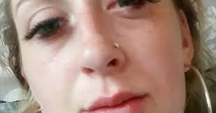 Thamesmead woman blames eyelash extensions for 'swollen and bleeding' eye