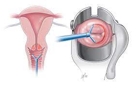 Ovarian cancer australia recommends women keep a symptom diary, which will help them track their overall health, and record possible symptoms of ovarian cancer or other less serious conditions. Endometrial Ovarian And Cervical Cancer