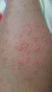 After you wipe off the cream with a towel, boom—your hair's all gone. Why Do I Have White Itchy Bumps After My First Diode Laser Hair Removal Treatment Photos