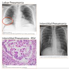 Image result for Pneumonia