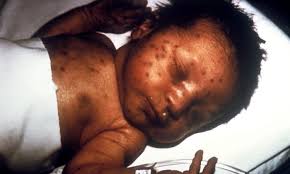 Image result for Rubella