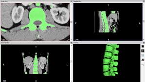 3d Printed Spine From Ct Scan Album On Imgur
