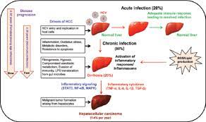 Cirrhosis of the liver is a condition in which scar tissue replaces normal, healthy tissue, blocking the flow of blood through the organ and preventing it cirrhosis is the end stage of chronic liver disease in which much of the functional liver tissue has been replaced by fibrous tissue, and eventually leads. Schematic Diagram Representing Different Stages Of Hcv Induced Liver Download Scientific Diagram