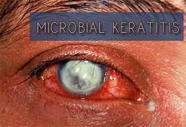 Image result for Keratitis