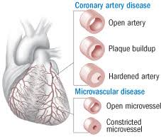 New View Of Heart Disease In Women Harvard Health