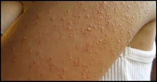 10 Signs That You Have Allergy Of Gluten And You Are Ignoring It Infousk