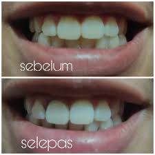 Biaya tambal gigi depan patah. Putihkan Gigi Anda Tampak Berseri Dengan Produk Whitekish Lia Hasty