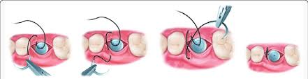 Check spelling or type a new query. External Vertical Mattress Suture Download Scientific Diagram