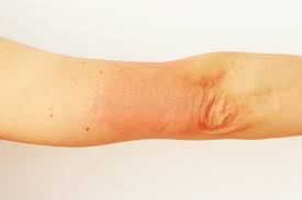 Image result for Photodermatitis