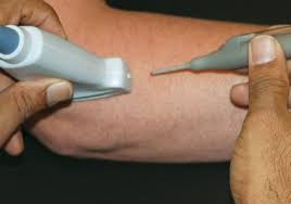 U ranom stadiju bolesti liječenje se provodi injekcijama kortikosteroida i lokalnog anestetika u područje upaljenog hvatišta tetive za kost, bilo medijalni bilo lateralni epikondil. Teniski Lakat I Golferski Lakat Uzroci Simptomi I Lecenje Orthoexpert