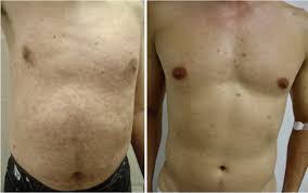 The signs and symptoms of syphilis vary depending in which of the four stages it presents. Sexually Acquired Syphilis Historical Aspects Microbiology Epidemiology And Clinical Manifestations Sciencedirect
