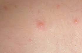 Learn about chickenpox (chicken pox) signs, symptoms, causes, and treatment for this highly contagious viral infection. Bahaya Ke Jangkitan Cacar Klinik Pakar Kanak2 Dr Saiful Facebook