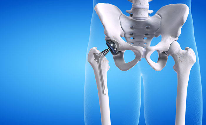 Hip Replacement Surgeon product image