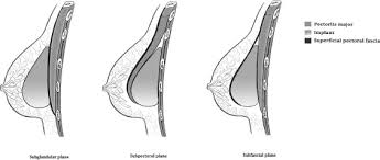 Part of this is due to their lifetime warranty and also because mentor some other implant brands used in australia include A Comparative Assessment Of Three Planes Of Implant Placement In Breast Augmentation A Bayesian Analysis Journal Of Plastic Reconstructive Aesthetic Surgery