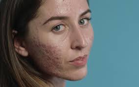 Skin: Ivy's Acne Journey