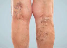 Varices - Insuffisance veineuse - Angiomalo