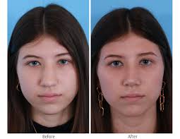 Clair shores, macomb township, rochester hills, grosse pointe, and sterling heights, mi lakeshore ear, nose & throat center is one of metropolitan detroit's leading otolaryngology centers, thanks to our dedication to providing comprehensive care with a staff that is fully trained and experienced in. Rhinoplasty Chicago Dr George Moynihan Nose Job