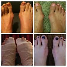 Documenting My Double Bunionectomy Bunion Surgery Experience Includes Many Pictures Following The Progress Of My Reha Bunion Bunion Surgery Surgery Recovery