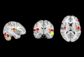 Brain abnormalities may also be involved, as scientists have revealed structural and functional differences in specific regions of the brains of children and children with asperger's. The Eternal Adolescence Of Autism Aspergers