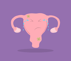 Superficial (peritoneal) disease, ovarian disease (endometriomas), and deep infiltrating endometriosis, which is the most complex and surgically challenging form. Endometriose Alerta Para Nossas Pacientes Mulheres