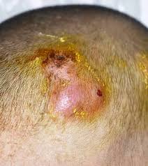 Image result for sores on the head in children