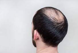 This phase iv clinical study is created by ehealthme based on reports submitted to ehealthme, and is updated regularly. Antihistamines Effective In Alopecia Areata Study