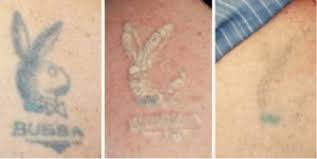 Eraditatt offers quality laser tattoo removal sessions at competitive prices. Is Laser Treatment Effective For Tattoo Removal Medisettermedisetter