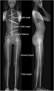 Image result for Functional Leg Length Discrepancy