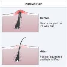 An ingrown hair cyst can be deep and painful in areas with hair such as the swimsuits, thighs, neck, face and armpits. How To Get Rid Of An Infected Ingrown Hair Ehow Ingrowing Hair Ingrown Hair Scar Ingrown Hair