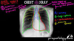 Vq mismatch and hyponatremia lectures have been popular. Learn To Read A Chest Xray In 5 Minutes Youtube