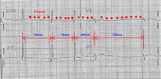 Parts of ekg waveform (image). Supraventricular Tachycardia Wikipedia