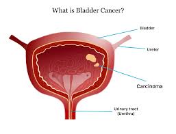 Blood may not be present in the urine all the time — it may come and go. Bladder Cancer Symptoms Causes Survival Rate And Treatment