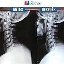 Maybe you would like to learn more about one of these? La Columna Cervical Centro Quiropractico Anglo Americano Facebook