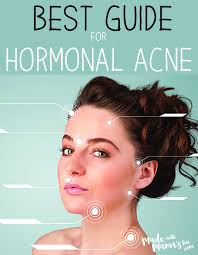 Treating Hormonal Acne Hormonal Acne Acne Treatment Jawline Acne