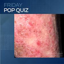Image result for Pustular Psoriasis