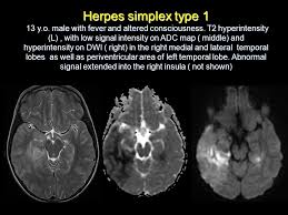 Nevertheless hsv detection in viral encephalitis is still critical because there is effective treatment for it. Nishard Abdeen Md1 Katya Rozovsky Md2 Nagwa Wilson Md3 Ppt Download
