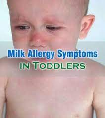 Common Milk Allergy Symptoms In Toddlers To Look For Milk Allergy Symptoms Allergy Symptoms Toddler Allergies