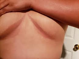 Image result for Candidiasis under breasts