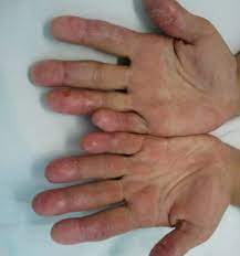 This fungal disease usually affects the skin. Sporotrichosis Diagnosis And Management Consultant360