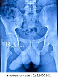 Image result for Retrograde Urethrogram