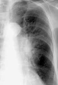 Image result for Air Bronchogram