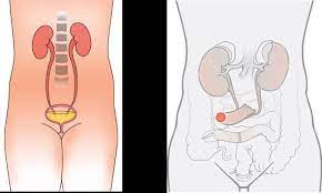The most popular diversions to date are made from ileal or ileocolonic segments. Stoma Universitatsspital Zurich