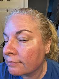 How to remove red lines