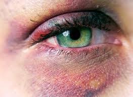 Black And Blue Eyes After Head Injury Pin On Bruises