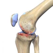 Knee joint replacement is a procedure that involves replacing an injured or ailing knee with an artificial joint,. Pin On Hip Flexor