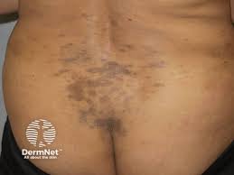 Image result for Diffuse Hyperpigmentation