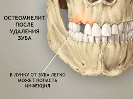Весь курс терапии происходит под строгим контролем лечащего врача, который наблюдает динамику воспалительного процесса, и в ходе может корректировать назначенное лечение; Osteomielit Chelyusti Prichiny Simptomy Diagnostika